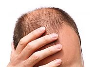 Is Hair loss and stress-related | what is the answer