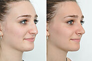 What is a rhinoplasty?