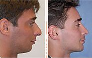 Why is male nose surgery so popular? | What are the advantages?
