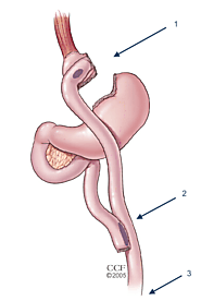 Duodenal Switch Bariatric Surgery