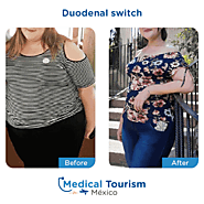 Bariatric weight loss surgery - duodenal switch information and locations in Mexico