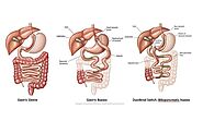 Bariatric surgery in children: necessity or exaggeration?