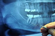 Root Canals Mexicali - Find the best Root canal treatment clinics in Mexicali