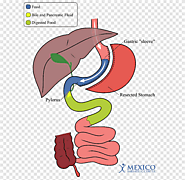 Gastric Bypass: Bariatric and Metabolic Surgery Perspectives - Google Libros