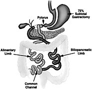 The Duodenal Switch Operation for the Treatment of Morbid Obesity