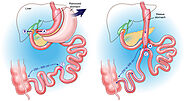 Duodenal Switch Surgery | Lenox Hill Bariatric Surgery Program, Manhattan NY