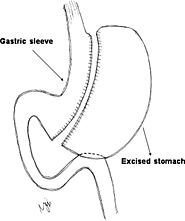 Duodenal Switch - an overview | ScienceDirect Topics