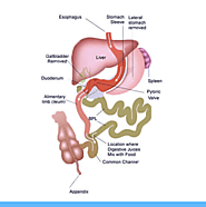 Duodenal Switch in Mexico | Tijuana Duodenal Switch Weight Loss Surgery