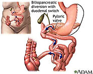 Duodenal Switch Surgery Abroad | Mexico, Belgium, India | BPDDS Cost