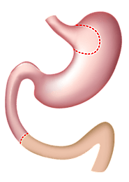 Duodenal Switch surgery in Saltillo | A Listly List