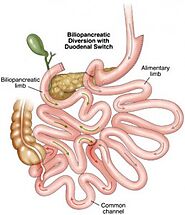 Duodenal Switch Mexico – Bariatric Surgery Mexico