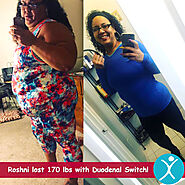 Duodenal Switch Surgery in Mexico: Certified Bariatric Surgeons $7,995