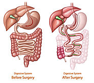 Duodenal Switch Houston, TX - Biliopancreatic Diversion - Northwest Endosurgical