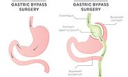 Duodenal Switch - Bariatric Journal