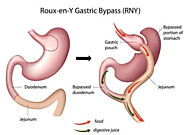 Gastric Bypass Surgery in Tijuana, Mexico | Gastric Bypass Services