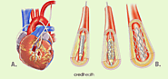 Heart Bypass Surgery vs Angioplasty - Which is better?