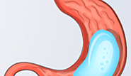 Gastric Balloon Surgery in Zapopan | A Listly List