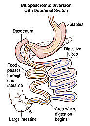 Duodenal Switch surgery in Chihuahua | A Listly List
