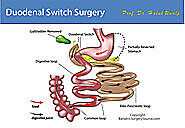 Duodenal Switch surgery in Naucalpan | A Listly List