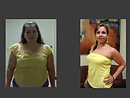 Gastric Bypass in Mexico | Bariatrics Cancun