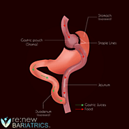 Gastric Bypass in Mexico | RNY Gastric Bypass in Tijuana, Cancun