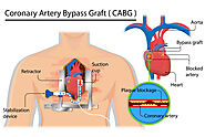 CABG (Bypass) Surgery Cost in India