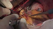 Coronary Artery Bypass Surgery: Internal Mammary Arteries (Graphic)