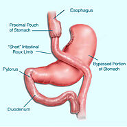 Gastric Bypass Surgery at Family Hospital in Mexicali