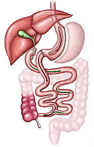Duodenal Switch surgery in San Luis Potosí | A Listly List