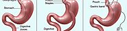 Duodenal Switch surgery in Reynosa | A Listly List