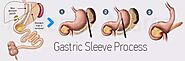 Gastric Sleeve Surgery Information Mexico - Is Gastric Sleeve Right For You