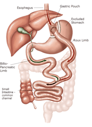 Gastric Bypass Surgery in Tijuana Mexico by Dr. Nunez