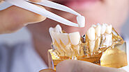 Teeth Implants in Gurgaon @9711811272 | Best Dental Implant Near Me