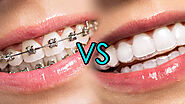 Best Metal Braces Dental Clinic in Gurgaon | Metal Braces Cost at @9711811272