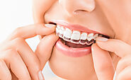 Clear Aligners Braces Near Me in Gurgaon | Clear Aligners Cost @9711811272