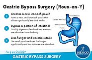 Roux-en-Y Gastric Bypass in Tijuana, Mexico - Starting at $5,795