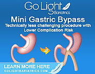 Mini Gastric Bypass Surgery in Mexico | Go Light Bariatrics