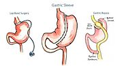 Gastric Sleeve Surgery in La Paz | A Listly List