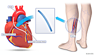 Coronary Artery Bypass Graft Surgery: The Past, Present, and Future of Myocardial Revascularisation