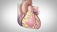 Coronary Artery Bypass Surgery