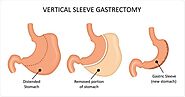 Gastric Sleeve Surgery in Jiutepec | A Listly List