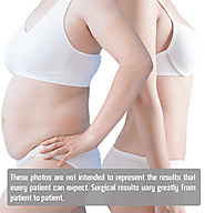Lap Band (Gastric Band) in Mexico at Angeles Hospital