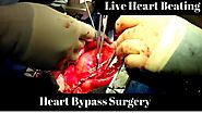 Heart Bypass Surgery| Live Heart Beating| Coronary Artery Bypass Surgery|