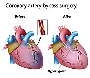 Heart Bypass Surgery Explained In Incredible Pictures • MyHeart