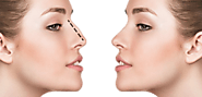 RHINOPLASTY WITH OR WITHOUT SURGERY?