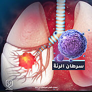 أعراض سرطان الرئة والتشخيص والعلاج في تركيا - بيمارستان