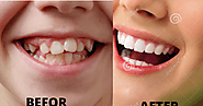 How to recover your teeth and gum with Steel bite pro latest reviews