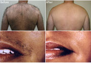 Timelessskincare.co.uk For Permanent Hair Removal In London