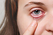 Blepharitis - Causes, Symptoms, and Treatment