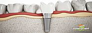 Best Dental Implants India - Implants Cost India - Cosmodent